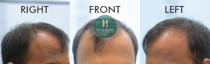 Before Procedure 4155